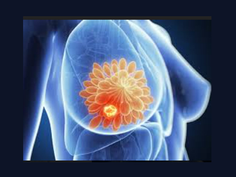 Breast Cancer