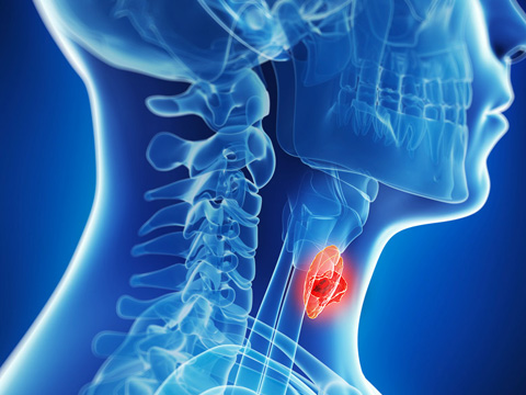 Head and Neck Cancer