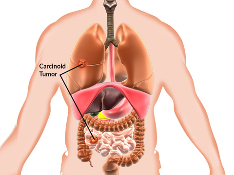 Neuroendocrine Tumor