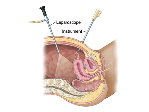 Laproscopic Surery