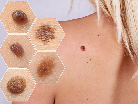 Skin Cancer