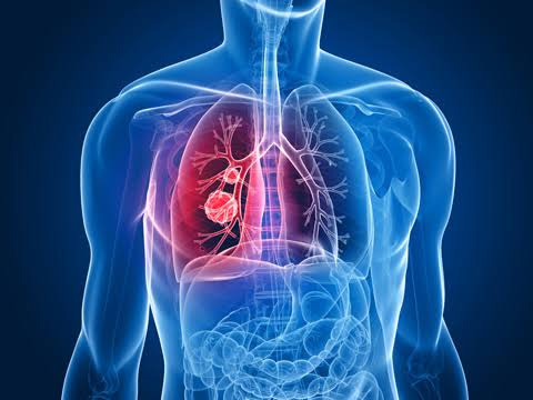 Thoracic Cancer