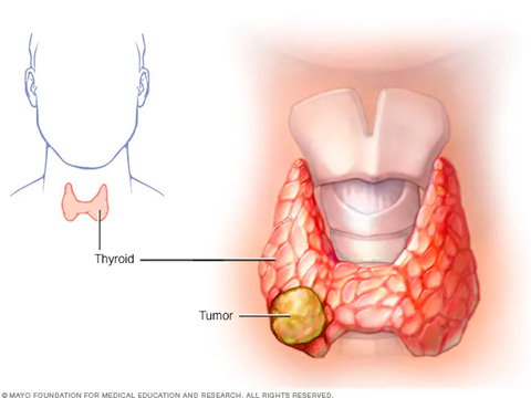 Thyroid Cancer